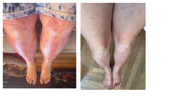 A collage of legs and legs with red rashes Description automatically generated