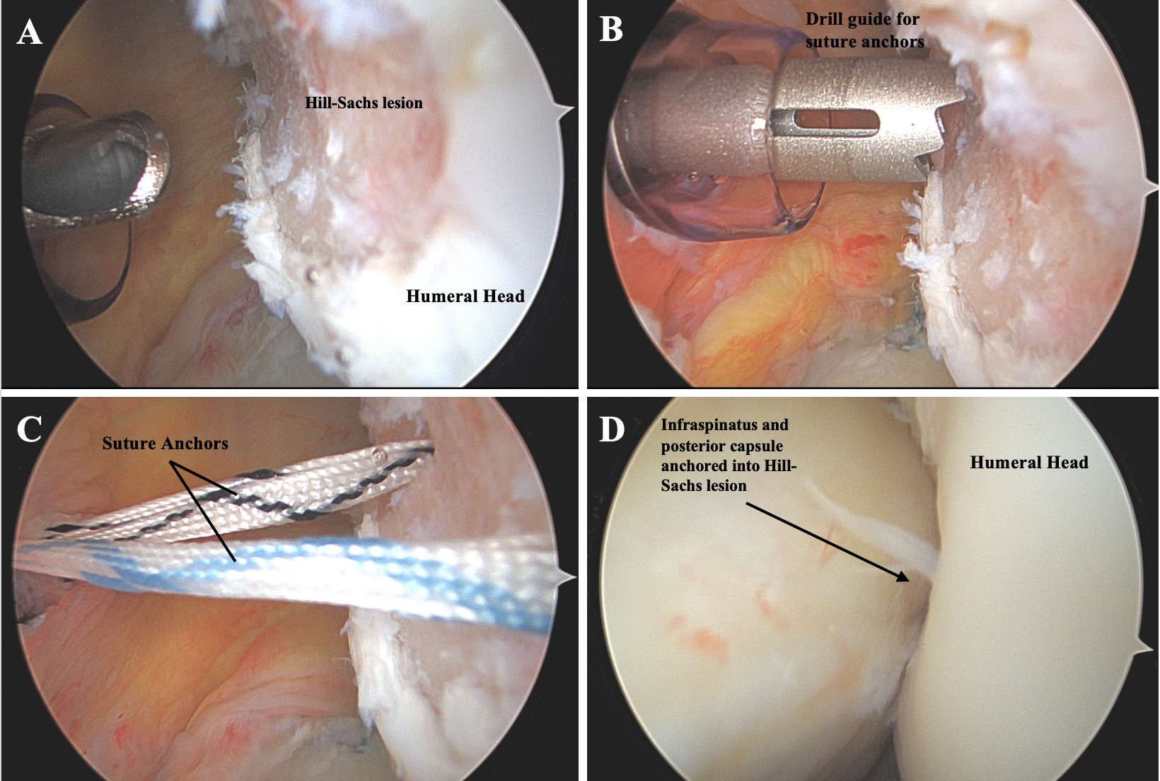 Close-up of a surgical operation AI-generated content may be incorrect.