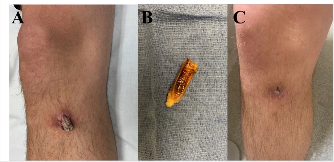 What Happens When a Surgical Screw Comes Loose? - Beebuze