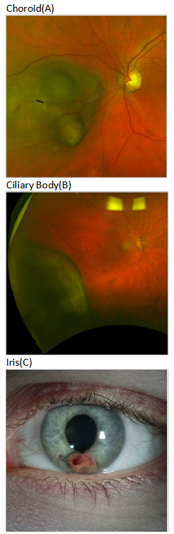 Uveal Melanoma | Published in Georgetown Medical Review