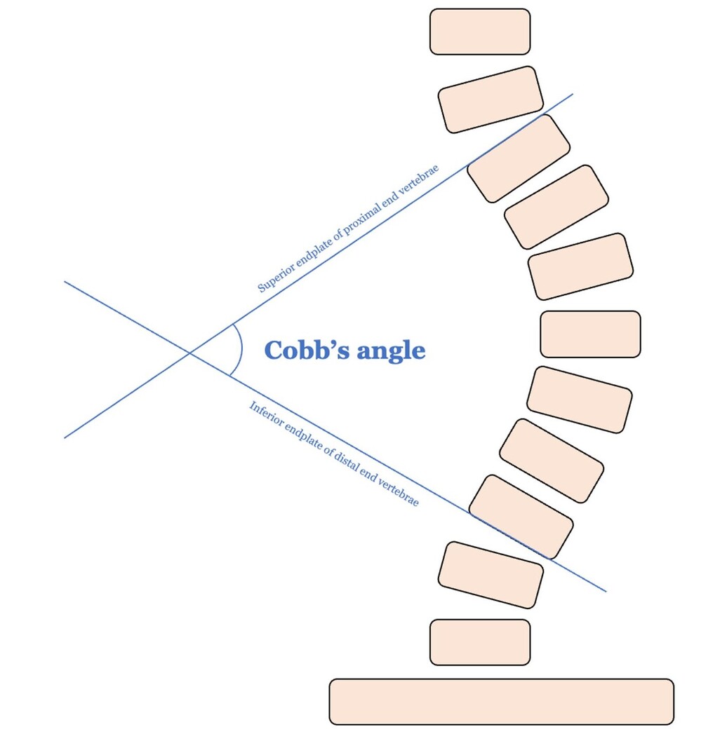 Automating Cobb angle measurement in adolescent idiopathic scoliosis based  on leveraging a computer vision algorithm | Published in Journal of  Orthopaedic Experience & Innovation