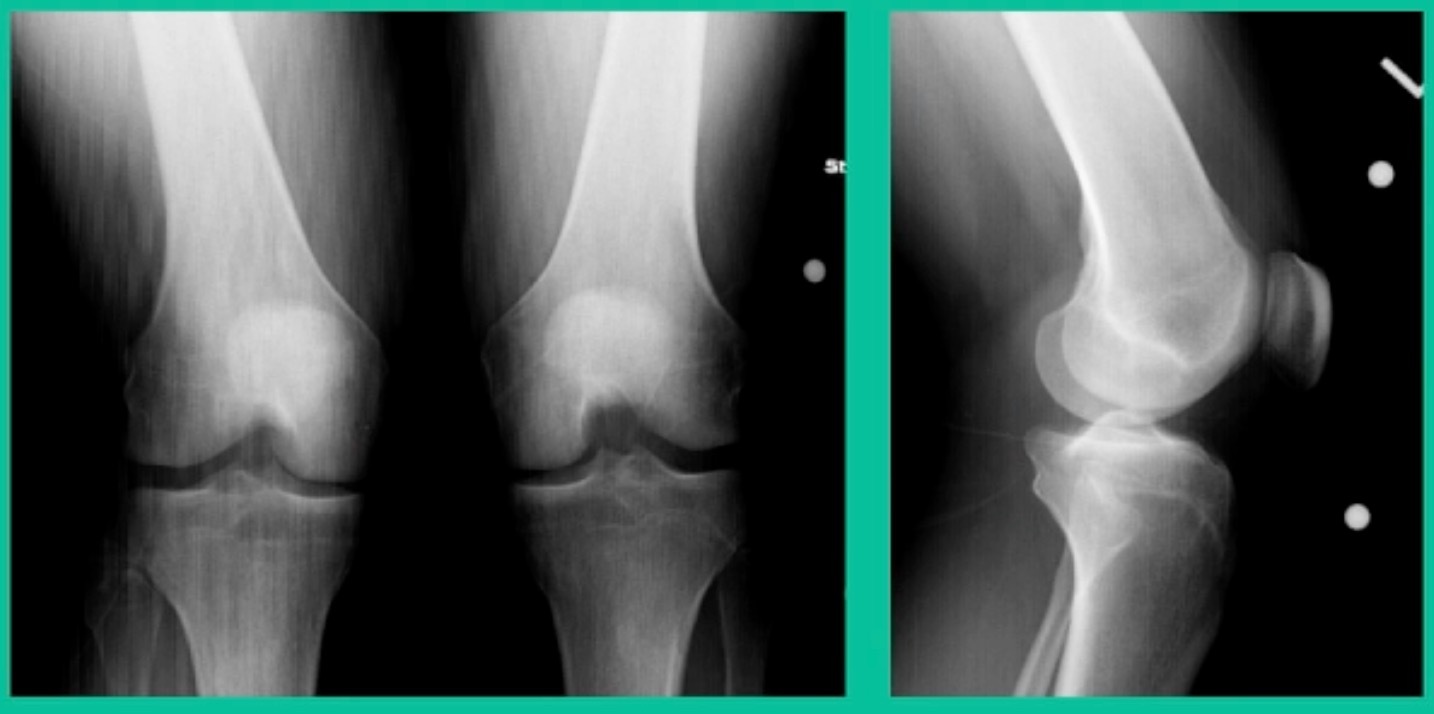X-ray of a knee joint AI-generated content may be incorrect.