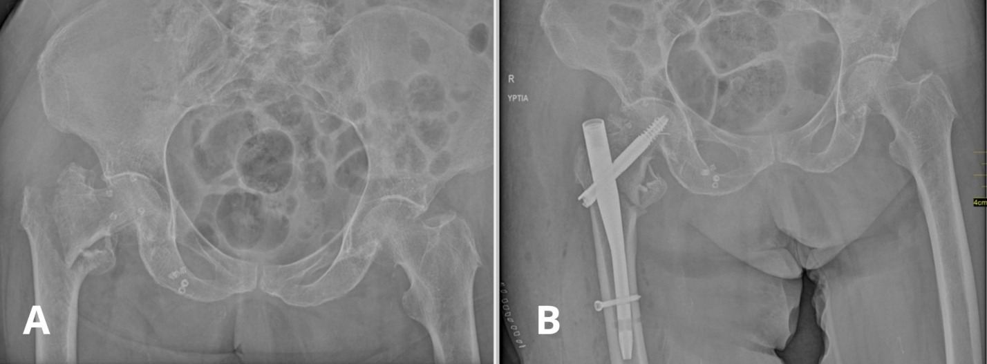 X-ray of a hip bone AI-generated content may be incorrect.