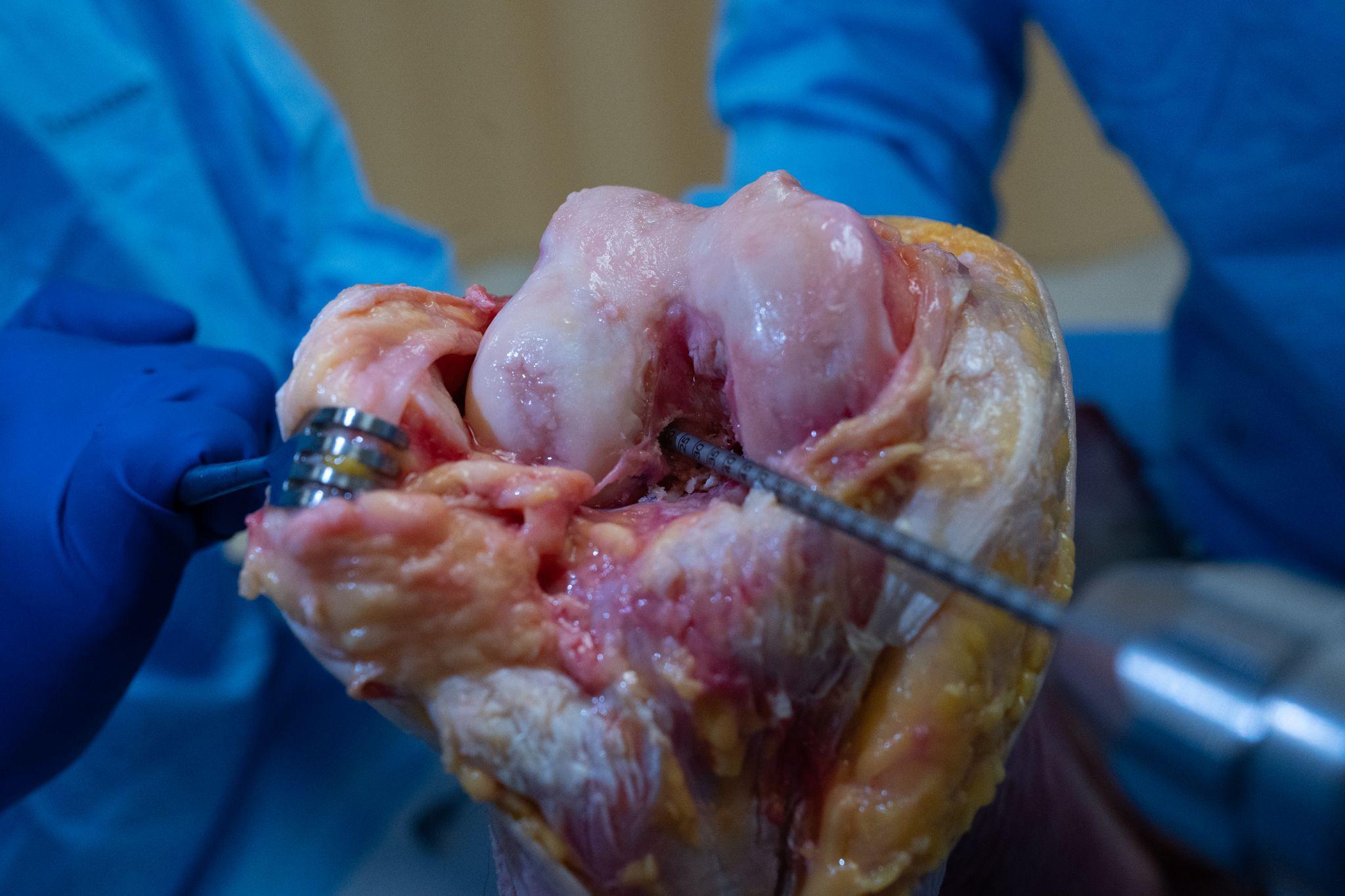 Close-up of a human bone surgery Description automatically generated
