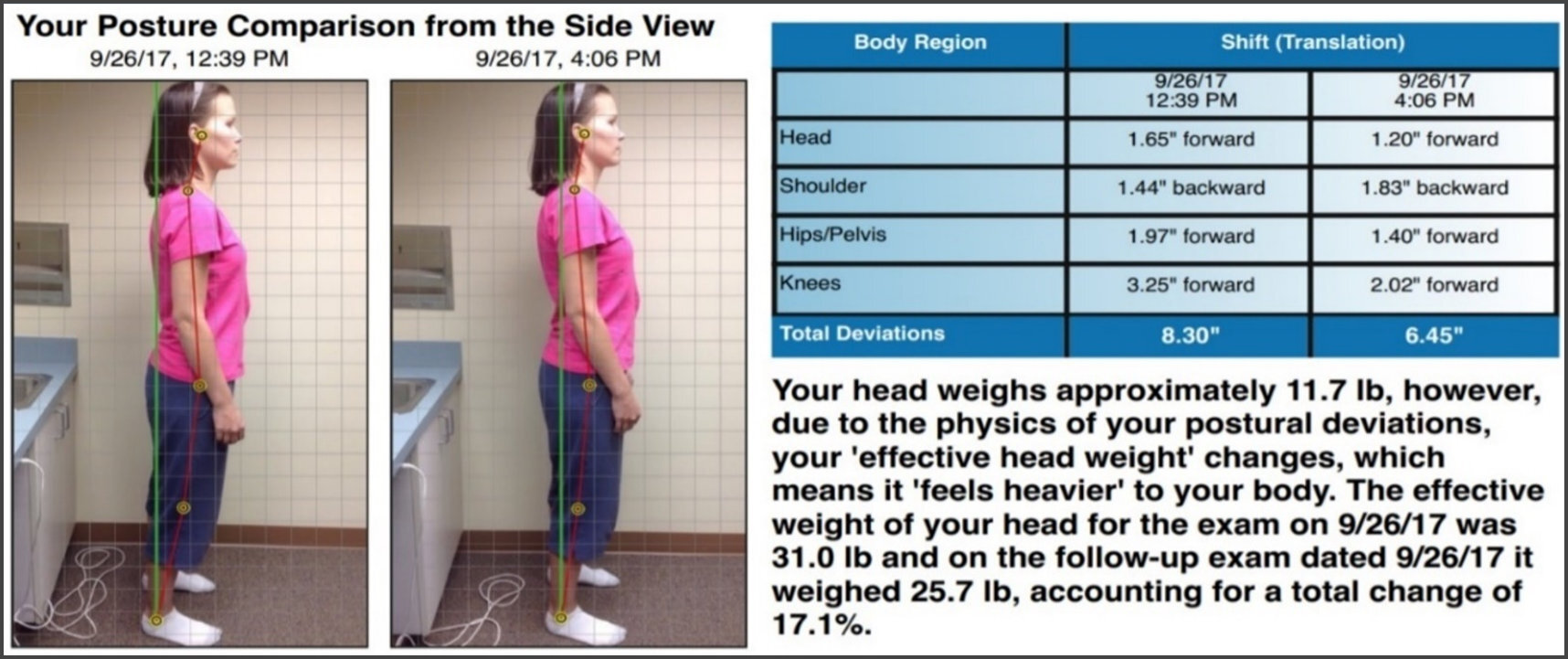 Posture Stability and Forward Head Posture Before and After Disclusion ...
