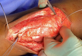A person with a surgical needle cutting a wound AI-generated content may be incorrect.