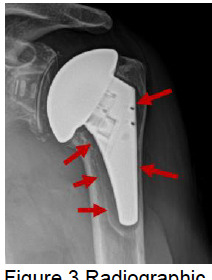An x-ray of a shoulder joint Description automatically generated