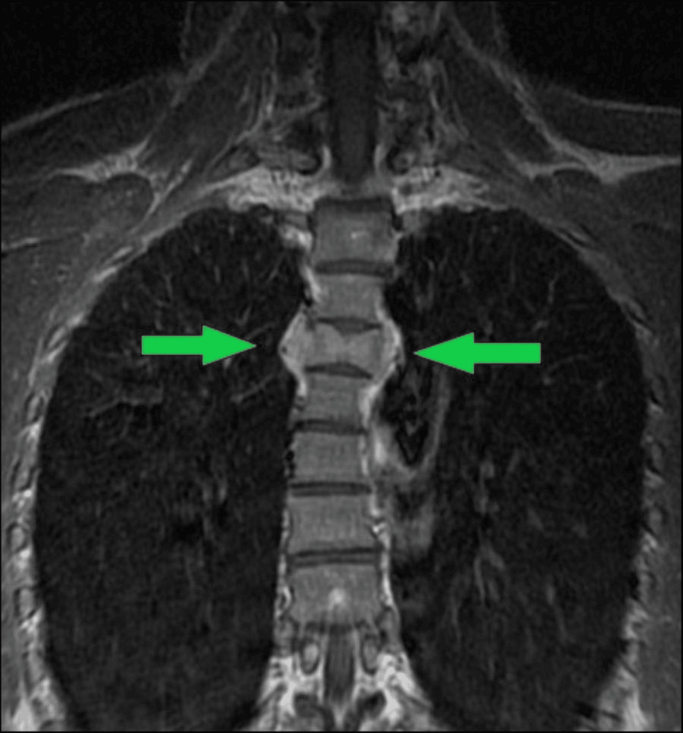 Coronal-T1-with-intravenous-contrast:--Osseous-expansion-with-infiltrative-marrow-signal-and-endplate-compression-noted-along-with-contrast-enhancement.-(Green-arrows)
