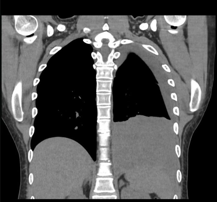 An x-ray of a chest Description automatically generated