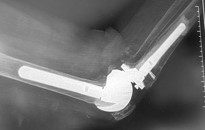 X-ray of a broken bone AI-generated content may be incorrect.