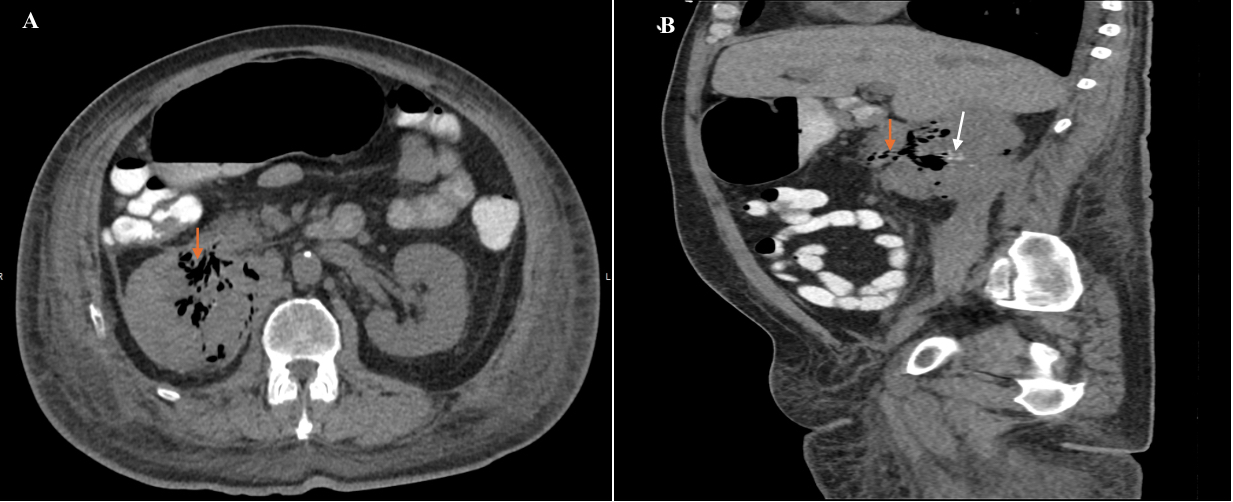 A close-up of a scan of a stomach AI-generated content may be incorrect.