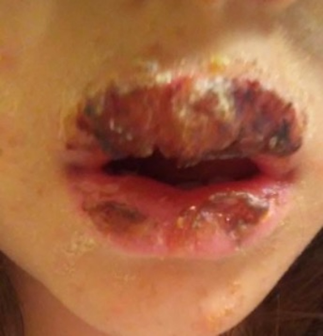 A close up of a person's mouth AI-generated content may be incorrect.