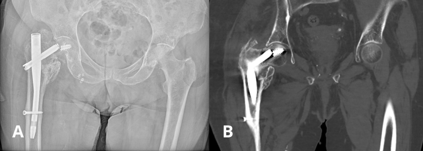 X-ray of a hip bone AI-generated content may be incorrect.