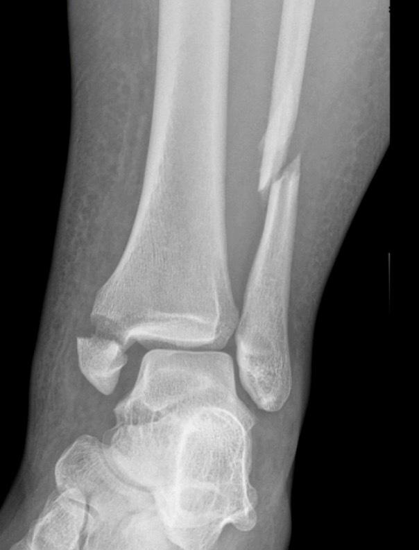X-ray of a broken leg AI-generated content may be incorrect.