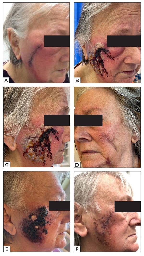 sweet's syndrome images