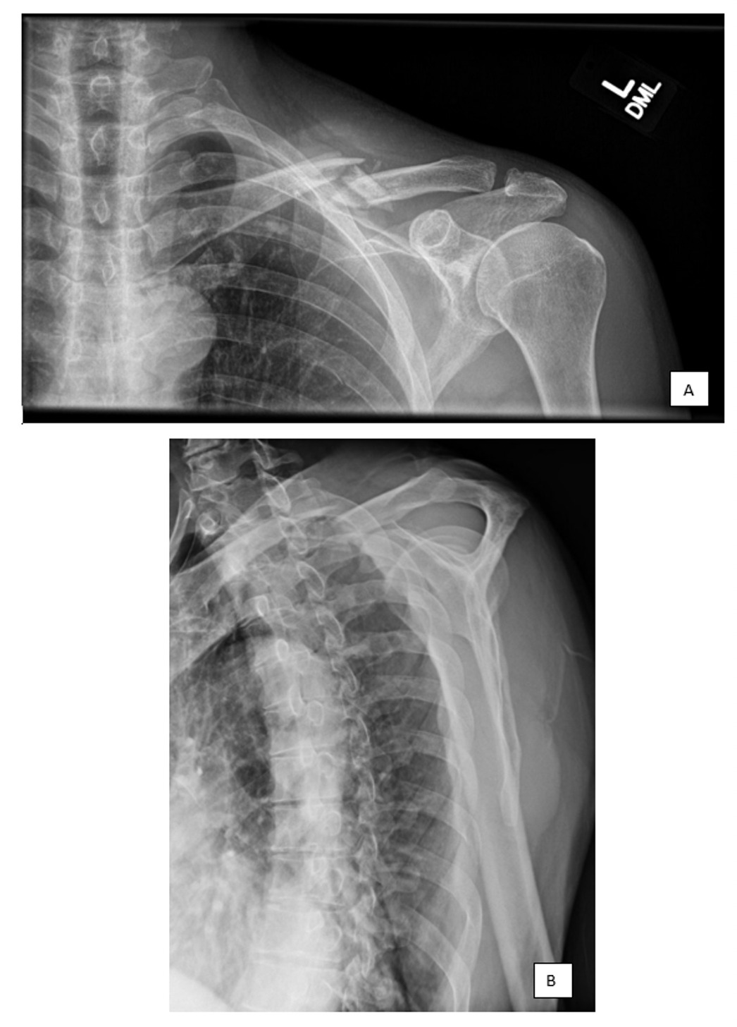 Tenting Skin Clavicle Fracture