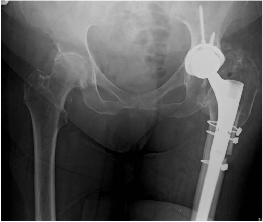 X-ray of a hip joint Description automatically generated