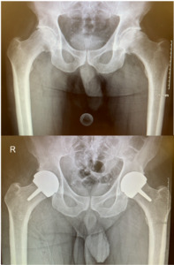 Hip Resurfacing Arthroplasty: Past, Present and Future | Published in ...