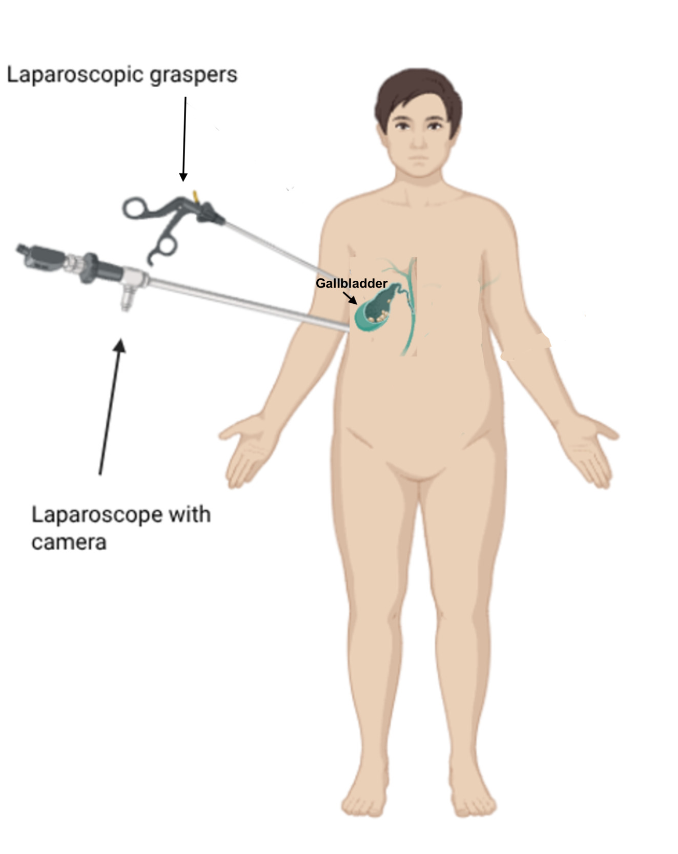 A person with a laparoscopy AI-generated content may be incorrect.