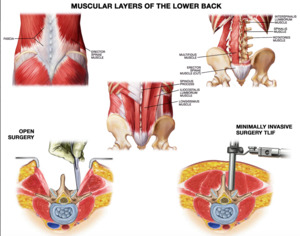 The Potential Elimination of Blood Transfusions in Lumbar Spine Fusion ...