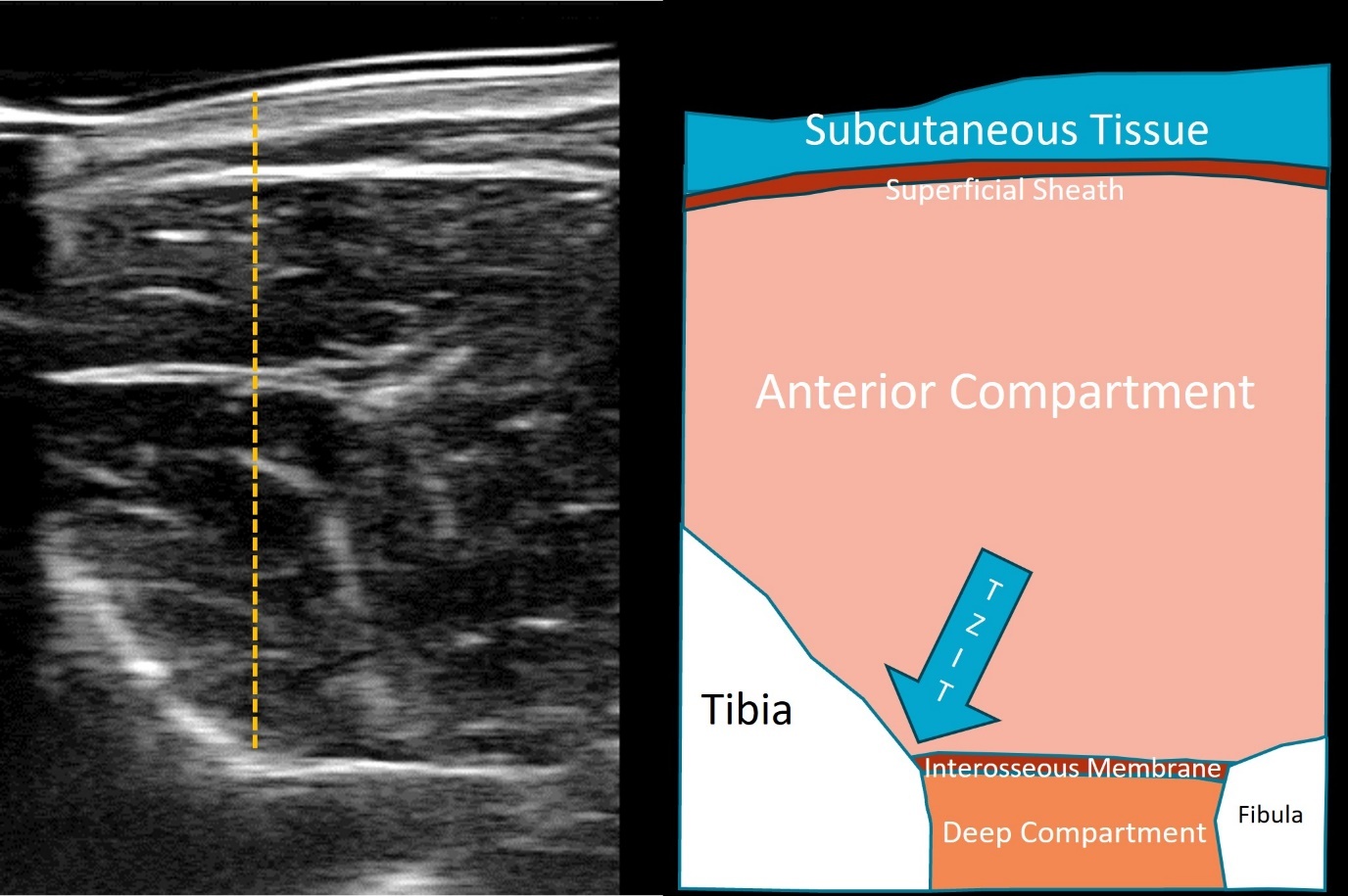 Compartment Sy Reliability of Ultrasound Based Compressibility of the Lower Leg ...
