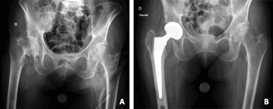 X-ray of a hip joint AI-generated content may be incorrect.