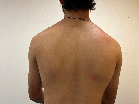 A person's back with a red mark AI-generated content may be incorrect.