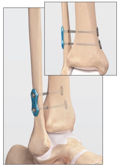 Management of High Ankle Sprains Utilizing the Tightrope Surgical ...