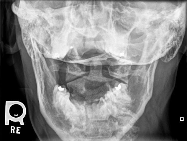 X-ray of a human skull Description automatically generated