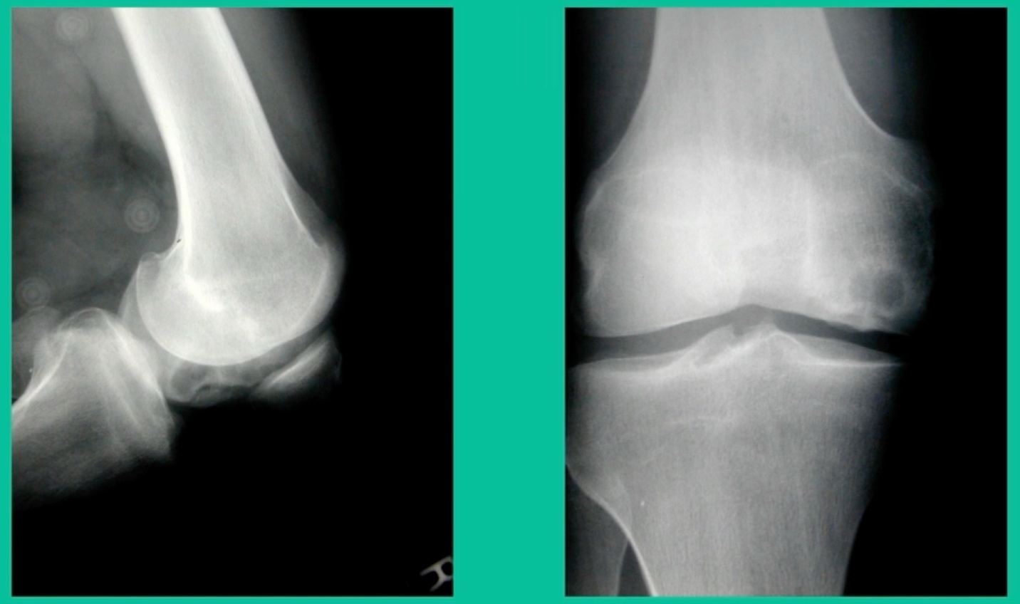 A close-up of x-ray images of a knee AI-generated content may be incorrect.
