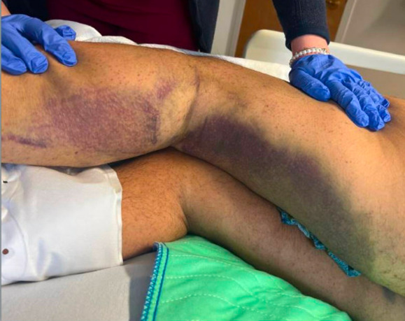 A person with purple gloves touching a person's leg AI-generated content may be incorrect.