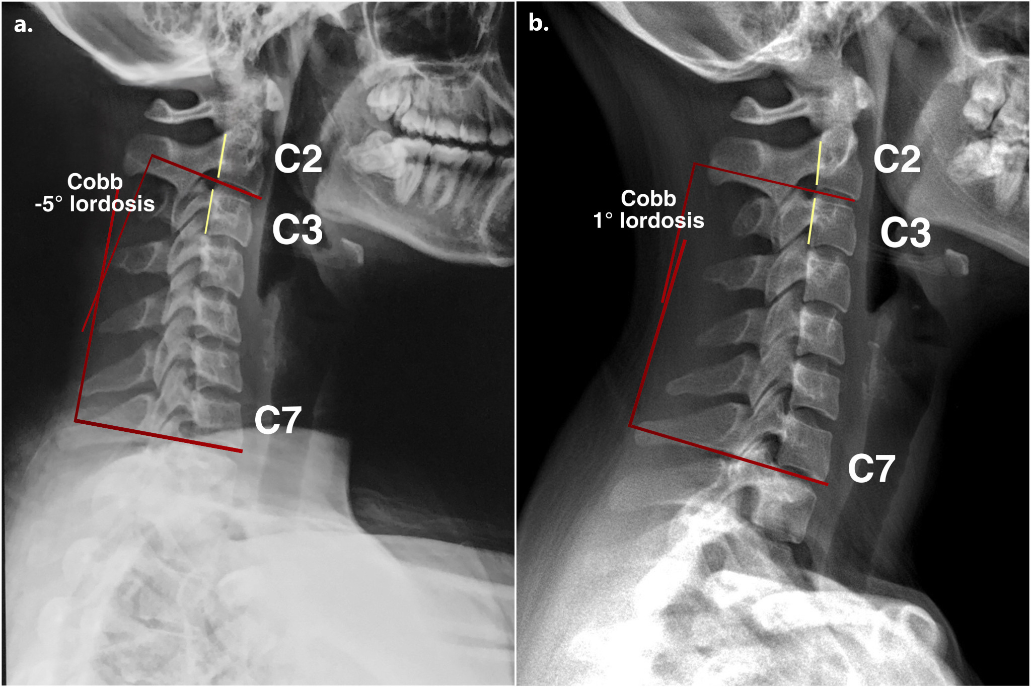 Normal Cervical Spine 740x540