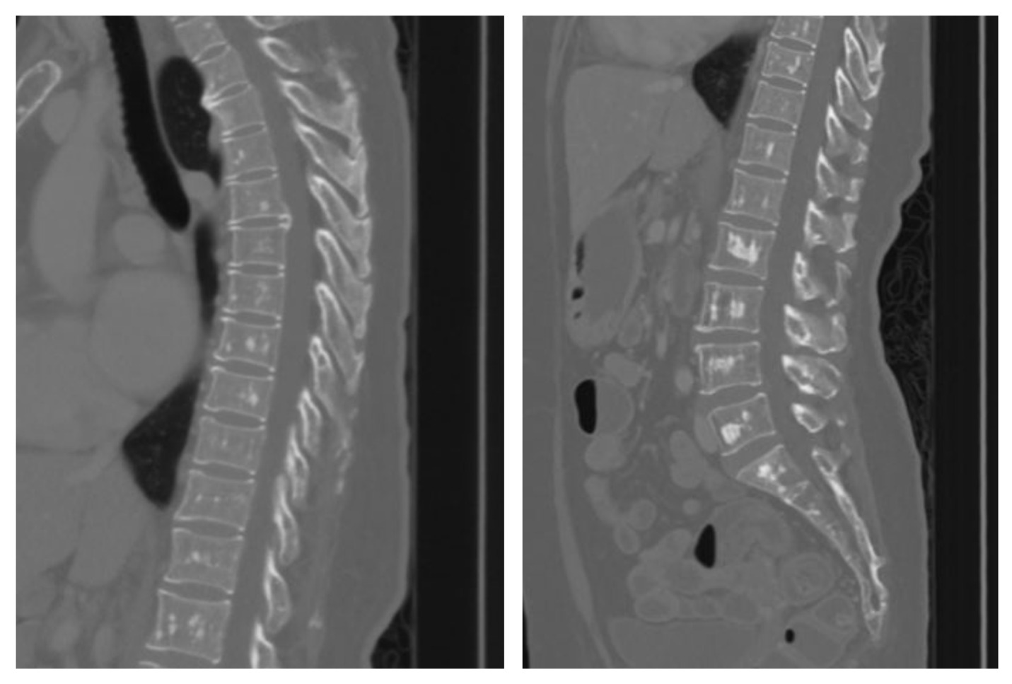 A close-up of a scan of a spine AI-generated content may be incorrect.