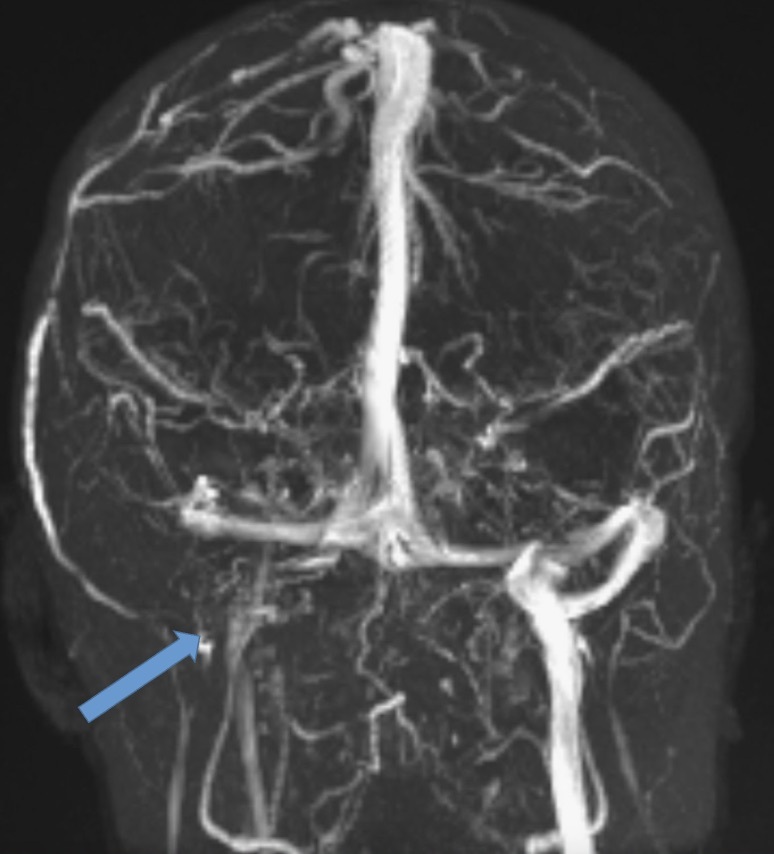 A mri of a brain AI-generated content may be incorrect.
