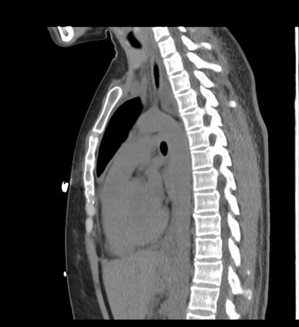 A close-up of an x-ray of a spine Description automatically generated