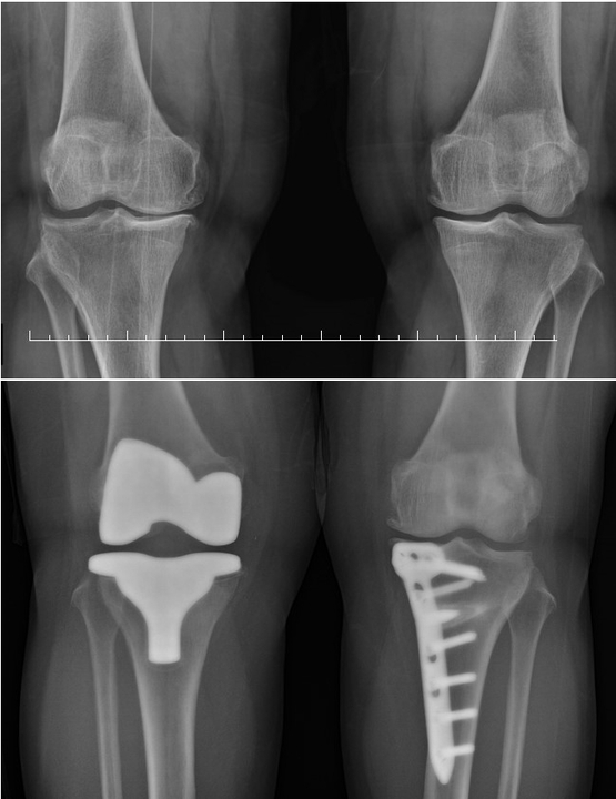 SIMULTANEOUS CONTRALATERAL HIGH TIBIAL OSTEOTOMY DURING TOTAL KNEE