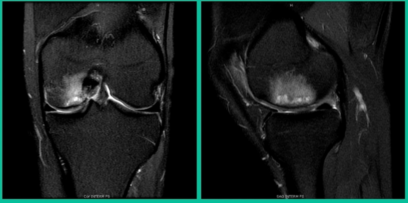 Close-up of a knee scan AI-generated content may be incorrect.