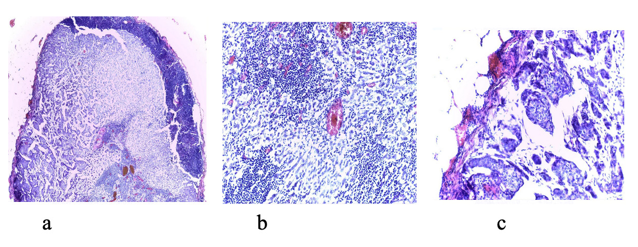 Preliminary results of sentinel lymph node biopsy using blue dye for ...