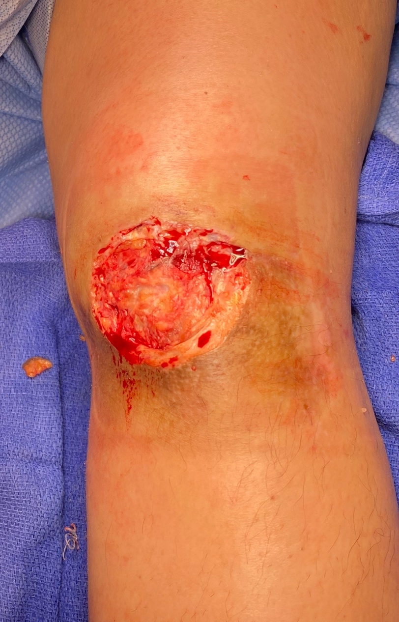 A wound on a knee Description automatically generated