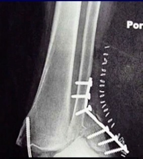 X-ray of a leg with screws AI-generated content may be incorrect.