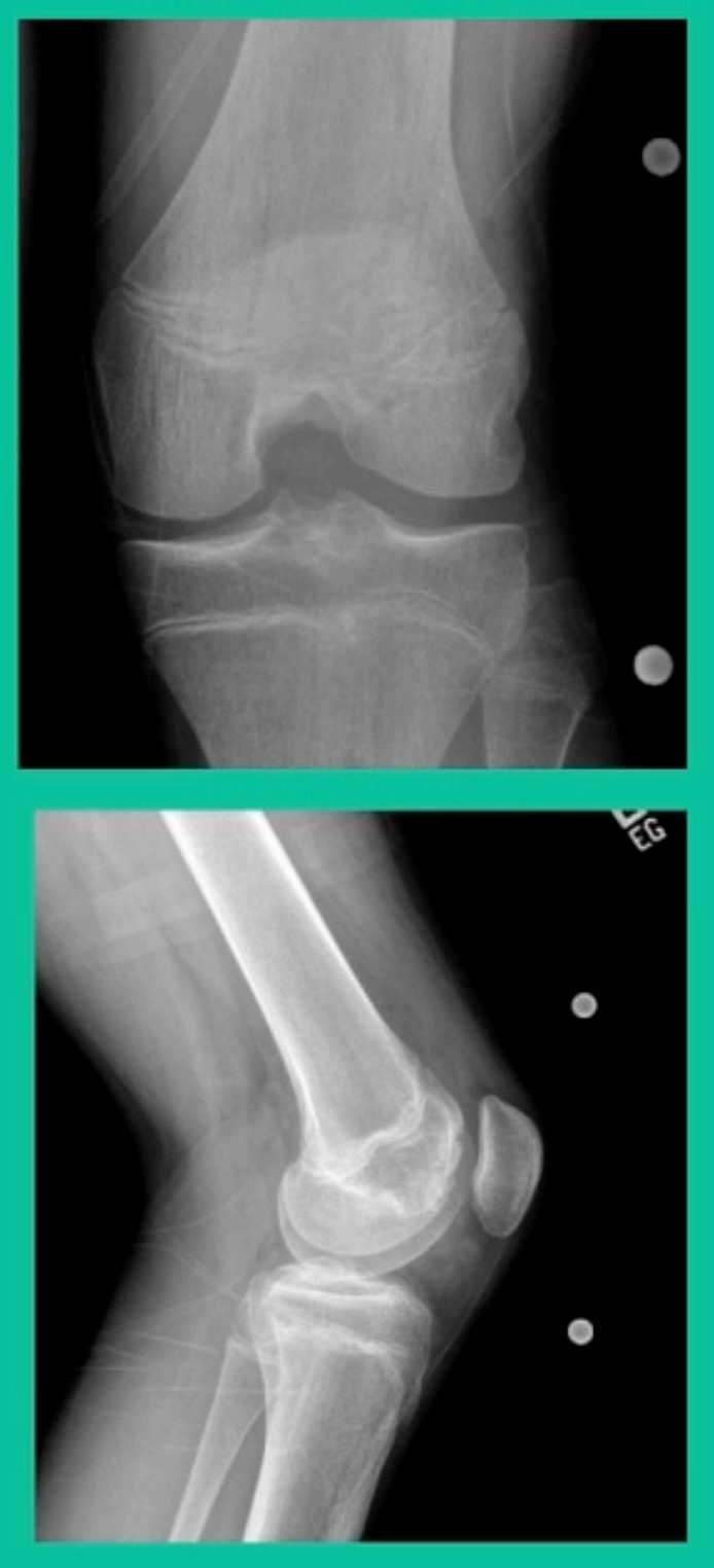 X-ray of a bone AI-generated content may be incorrect.