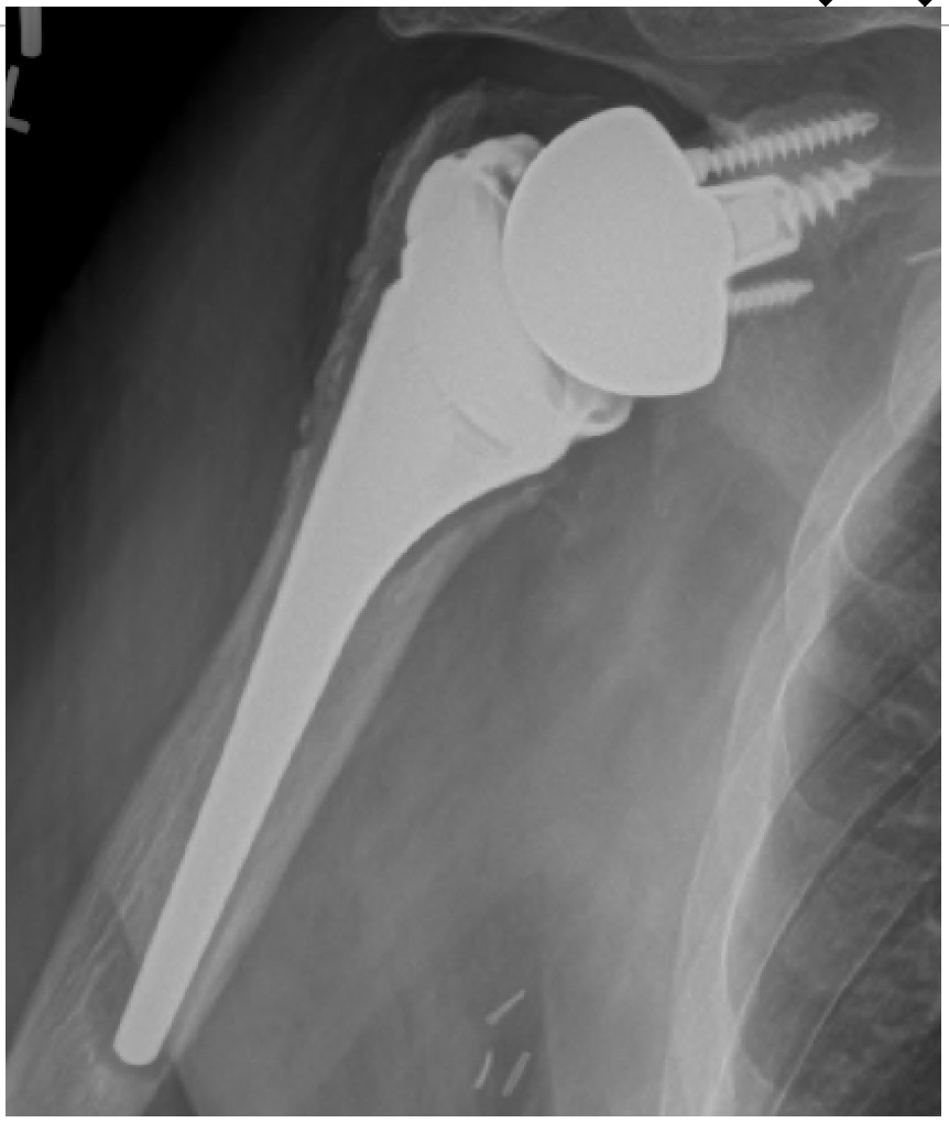 X-ray of a bone with screws Description automatically generated
