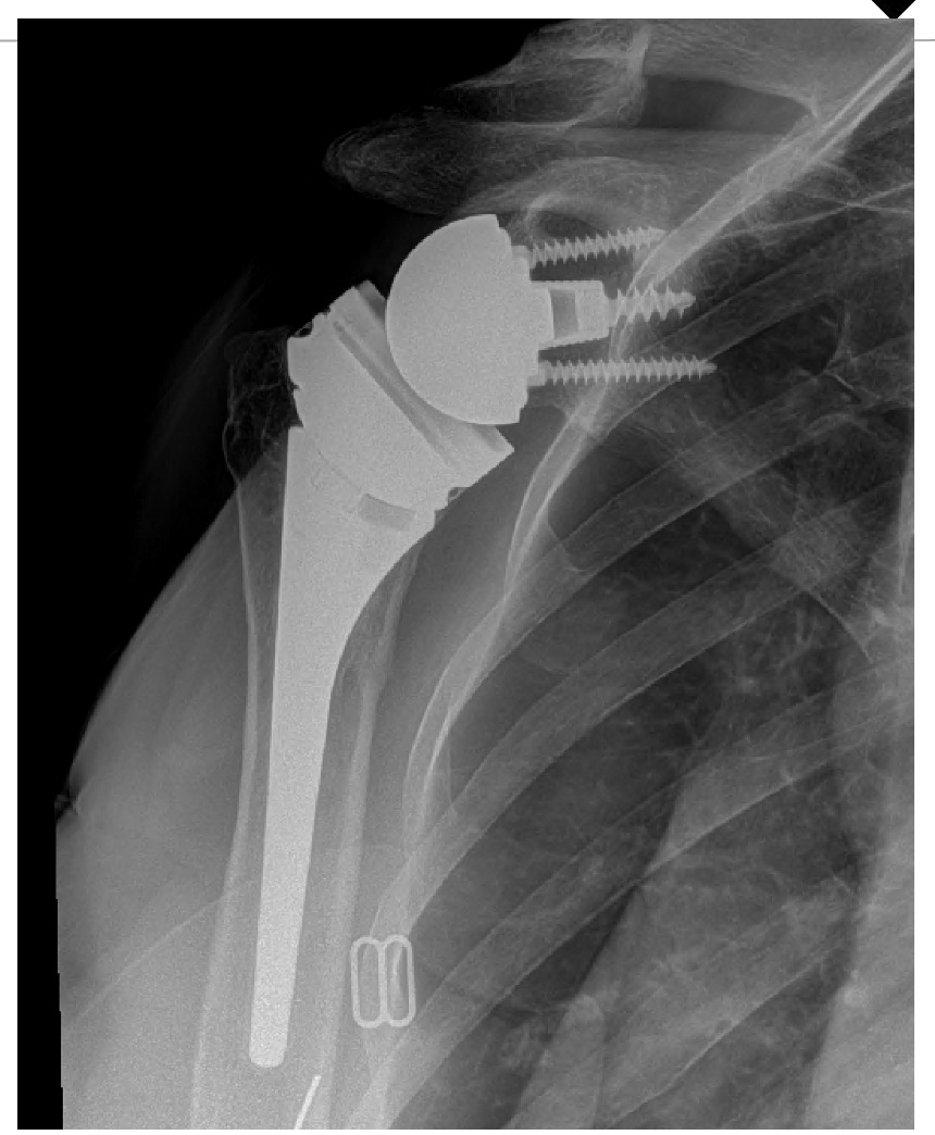 X-ray of a shoulder joint Description automatically generated