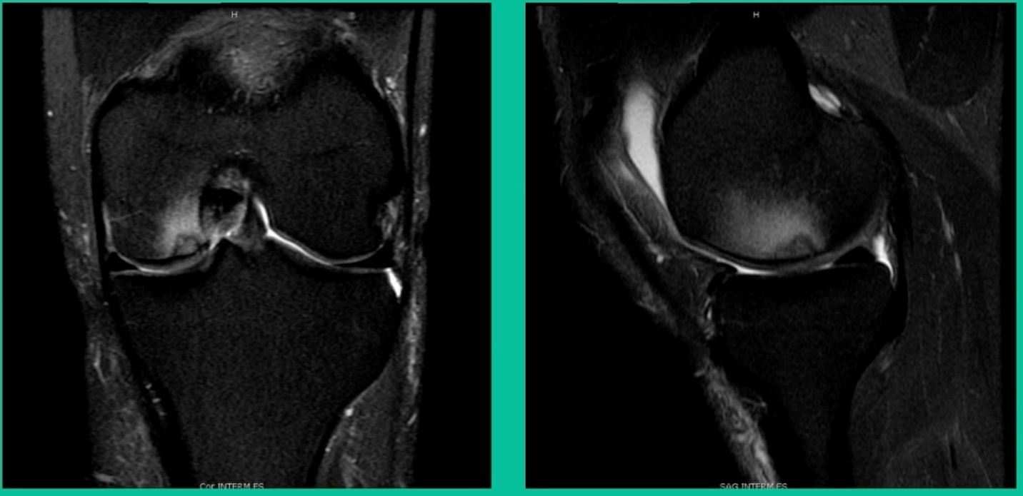 A close-up of a knee joint AI-generated content may be incorrect.