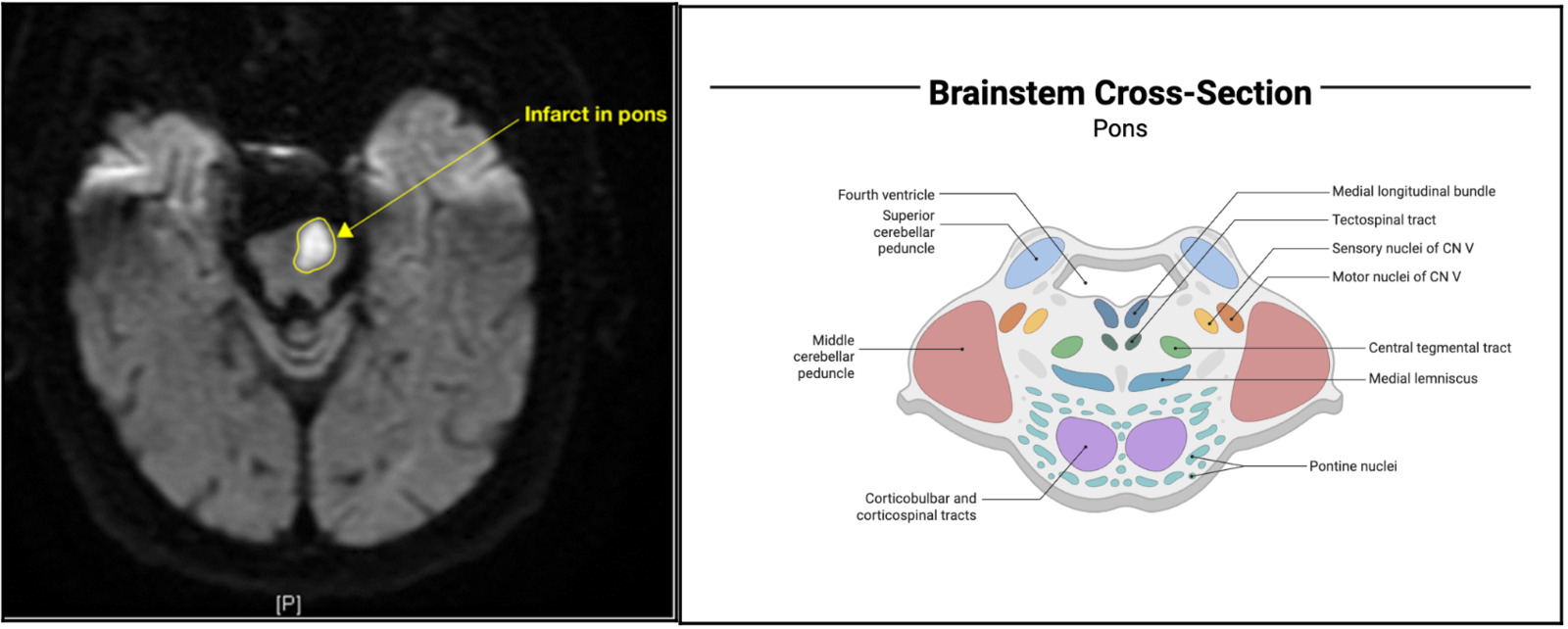 Lateral Pontine Syndrome Radiology