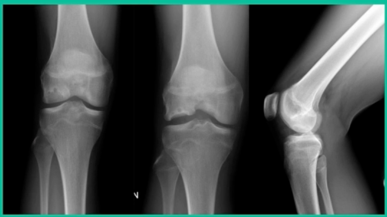 X-ray of a knee joint AI-generated content may be incorrect.