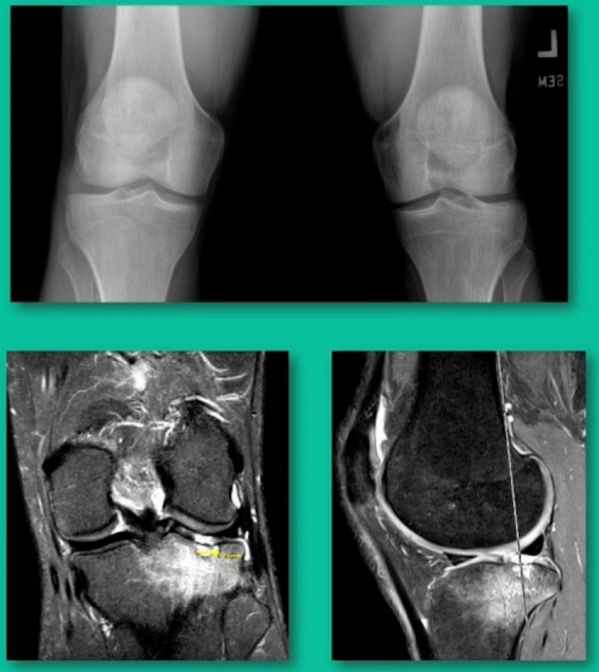 X-ray images of a knee joint AI-generated content may be incorrect.