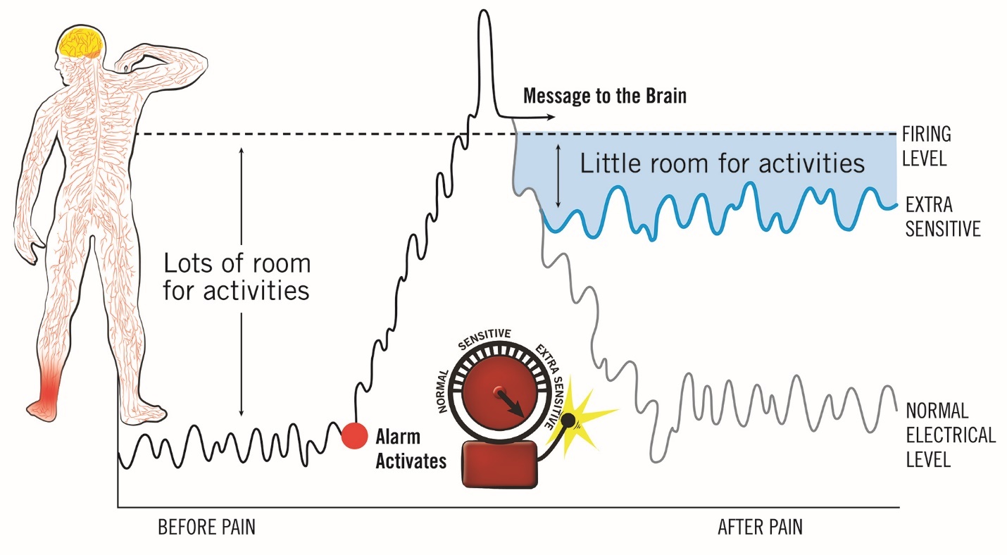 Pain Neuroscience Education for Acute Pain | Published in International ...