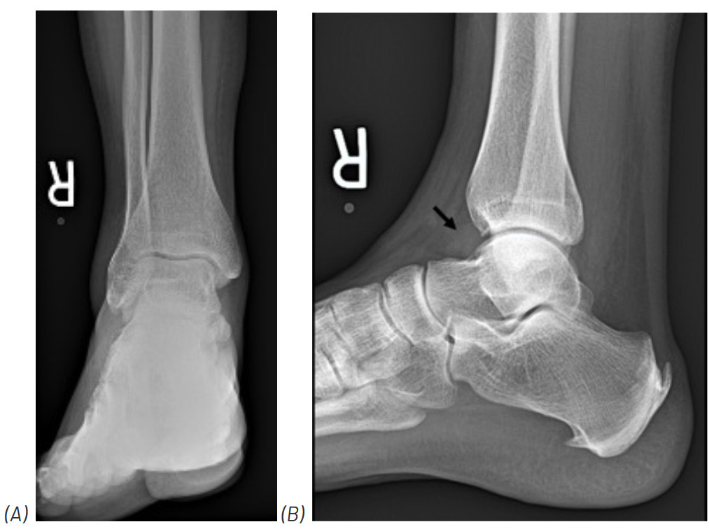 X-ray of a foot Description automatically generated