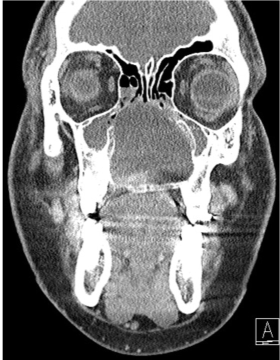 Nasopalatine Cyst On Ct Scan MR Imaging Of Nasopalatine Duct Cysts